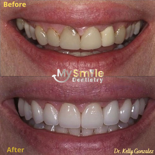 My Smile Dentistry | Dental Implants, Veneers and Fluoride