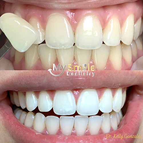 My Smile Dentistry | Emergency Dental Care, Veneers and Teeth Whitening
