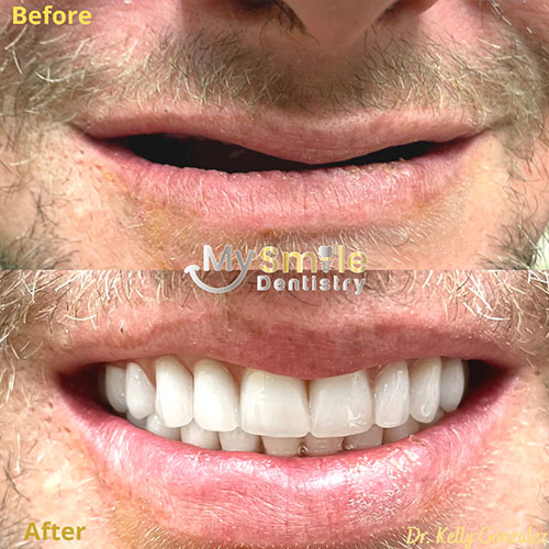 My Smile Dentistry | 6 Months Braces, Pediatric Dentistry and Smile Makeover