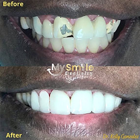 My Smile Dentistry | All-on-6, Fluoride and Pediatric Dentistry