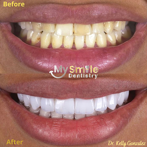 My Smile Dentistry | Veneers, Emergency Dental Care and Oral Cancer Screening