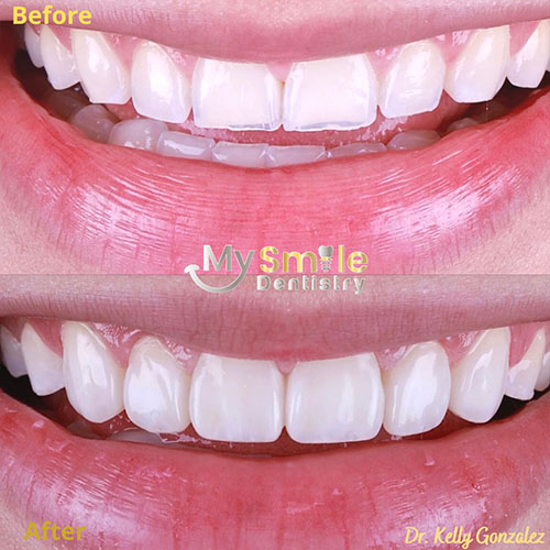 My Smile Dentistry | Teeth Whitening, Veneers and All-on-6