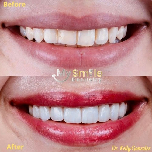My Smile Dentistry | Lumineers reg , 3D Guided Implant Surgery and Laser Gum Surgery