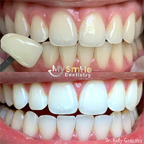 My Smile Dentistry | Laser Dentistry, Sealants and Veneers