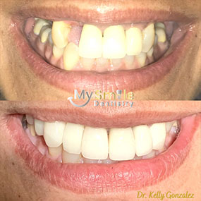 My Smile Dentistry | Cone Beam Volume CT, Fillings and All-on-6